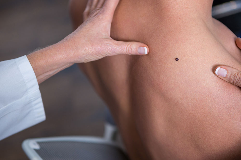 Melanoma &#8211; Key Signs and Symptoms