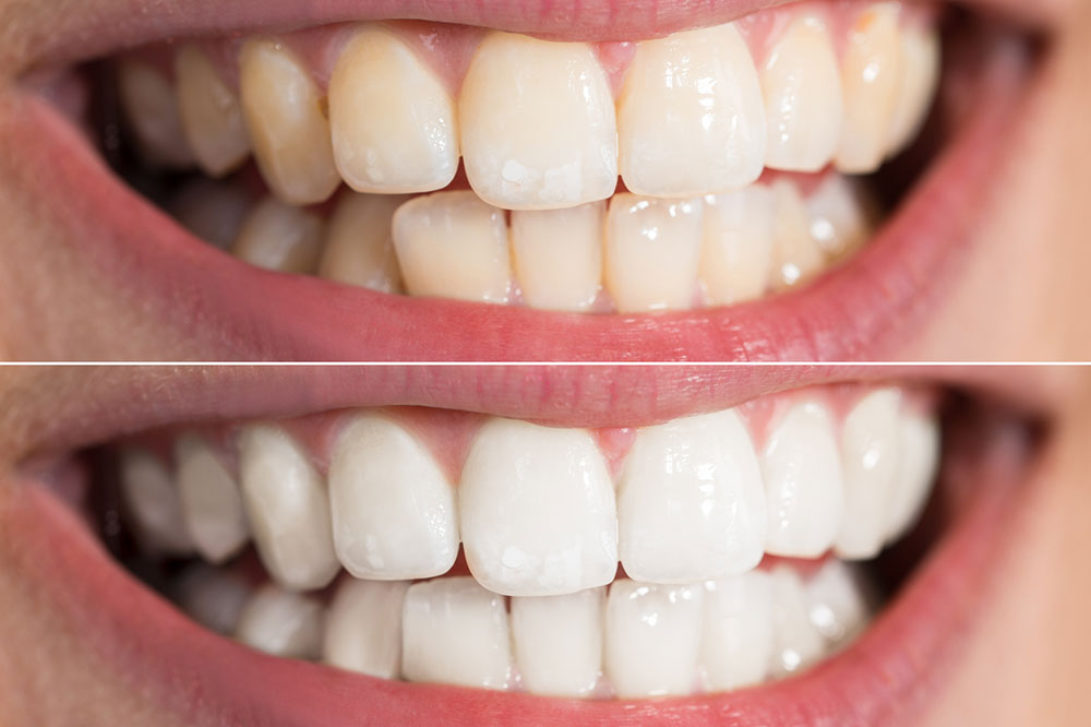 Natural Ways to Whiten Teeth at Home